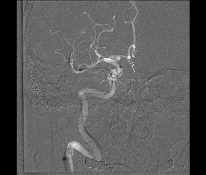 Angiographic case video three