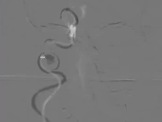 Angiographic case video one