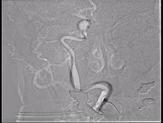 Angiographic case video two